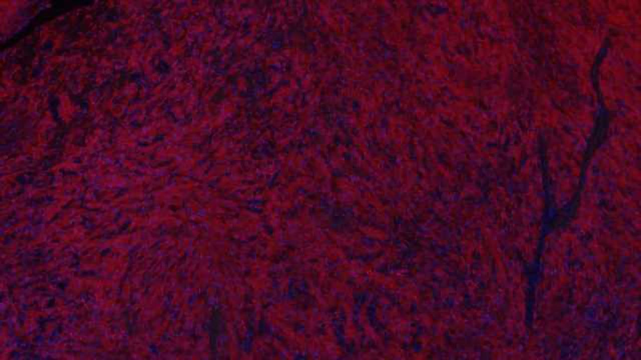 Could there be a Gleevec for brain cancer?