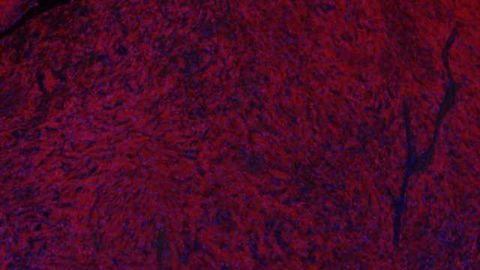 Could there be a Gleevec for brain cancer?