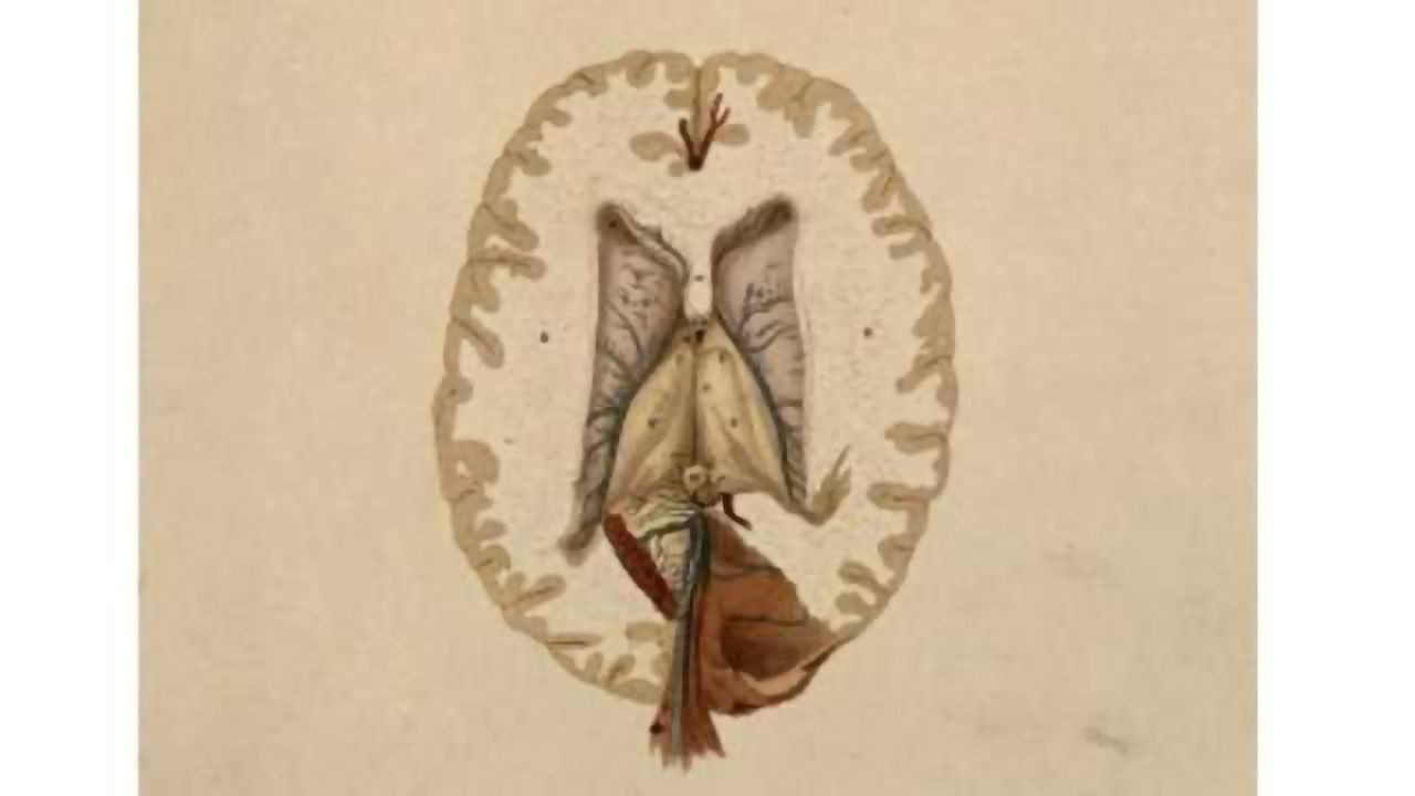 Schizophrenia: Impaired activity of the selective dopamine neurons