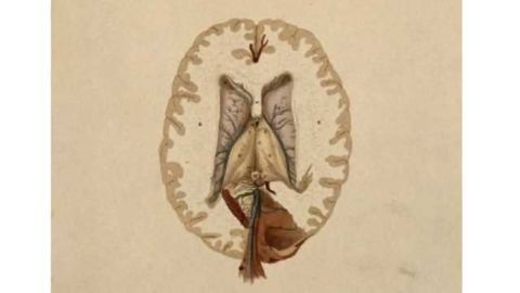 Schizophrenia: Impaired activity of the selective dopamine neurons