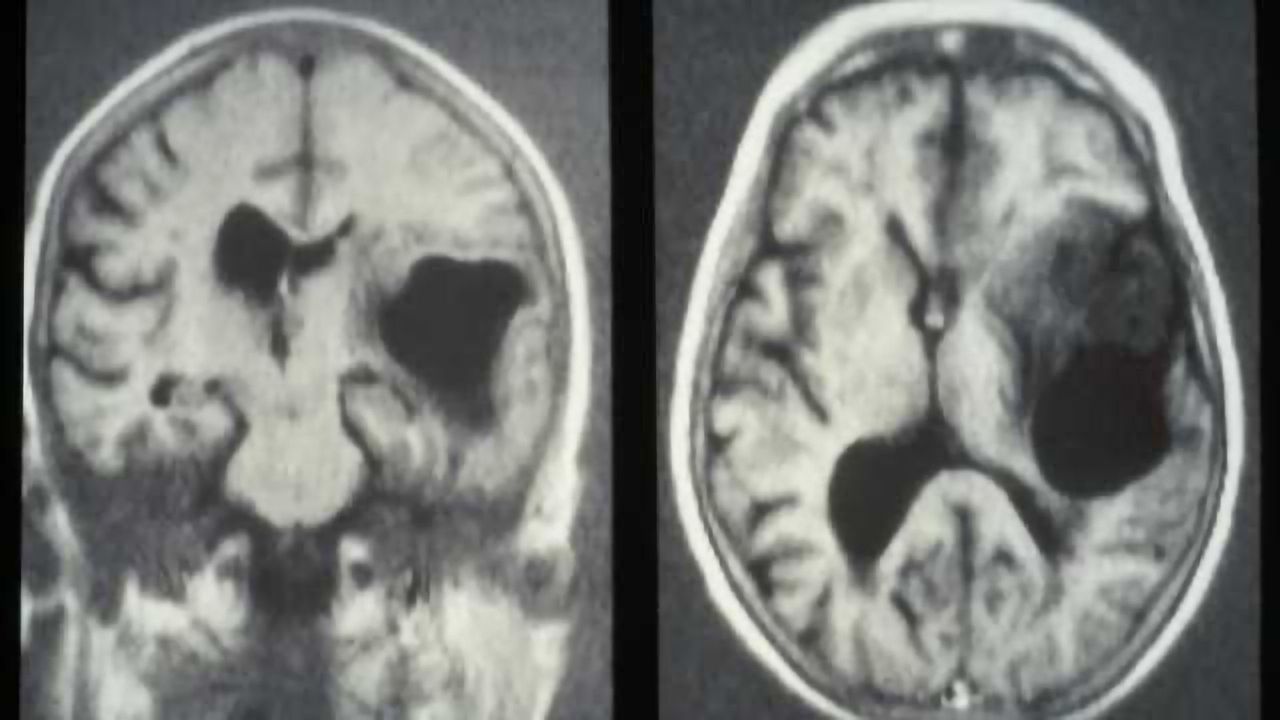 Study Describes Development of Personalized Cellular Therapy for Brain Cancer