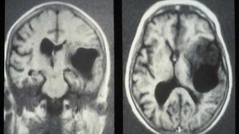 Study Describes Development of Personalized Cellular Therapy for Brain Cancer