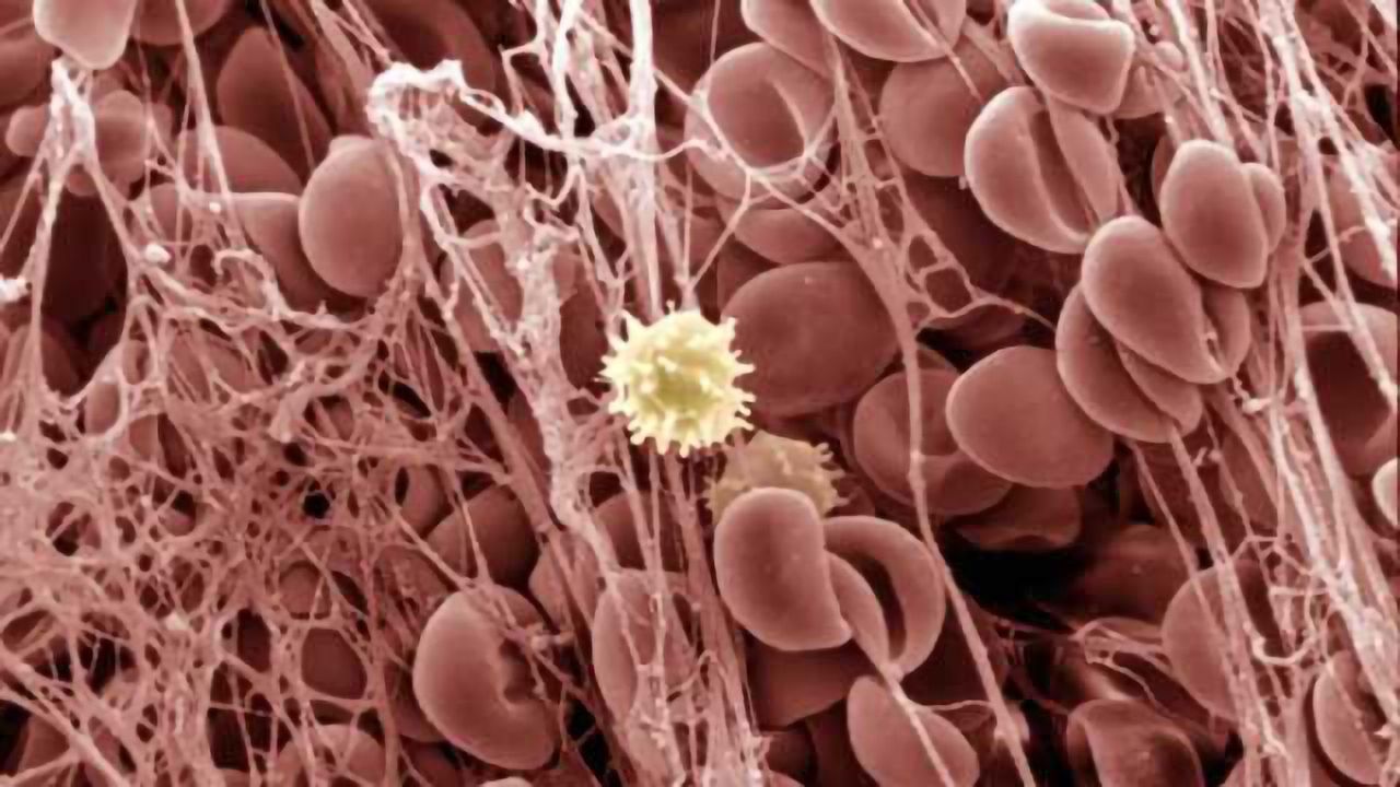 Magnetic nanoparticles could stop blood clot-caused strokes