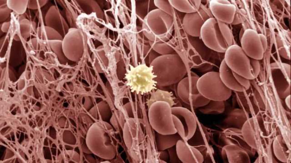 Magnetic nanoparticles could stop blood clot-caused strokes content piece image