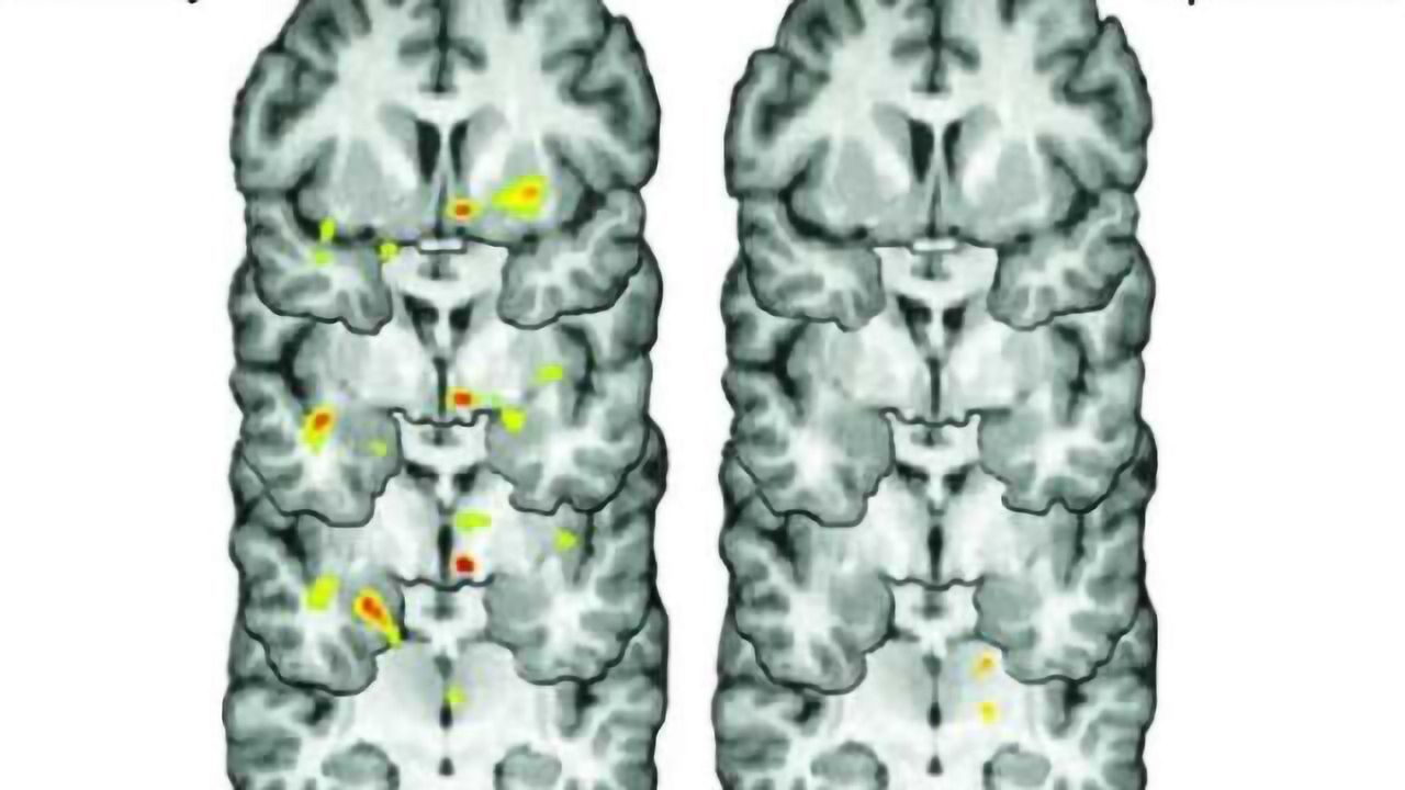 Shake it off? Not so easy for people with depression, new brain research suggests