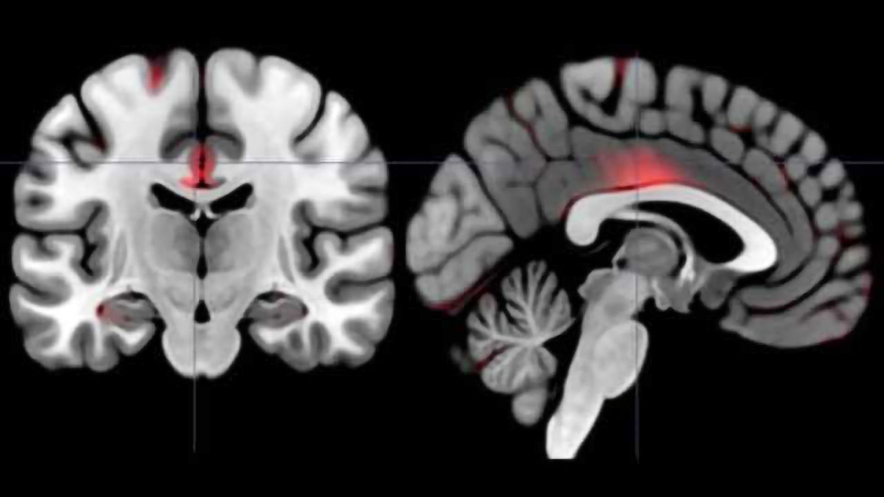 Study maps extroversion types in the brain’s anatomy