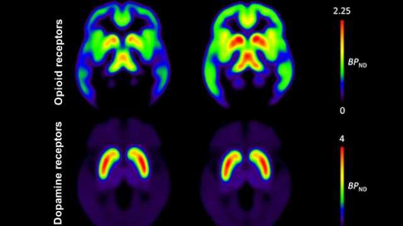 Obesity is associated with brain’s neurotransmitters