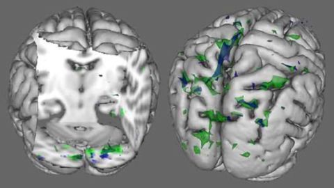 People with anorexia and body dysmorphic disorder have similar brain abnormalities, study shows