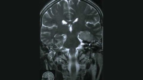 Clinical Trial Suggests Combination Therapy is Best for Low-Grade Brain Tumors