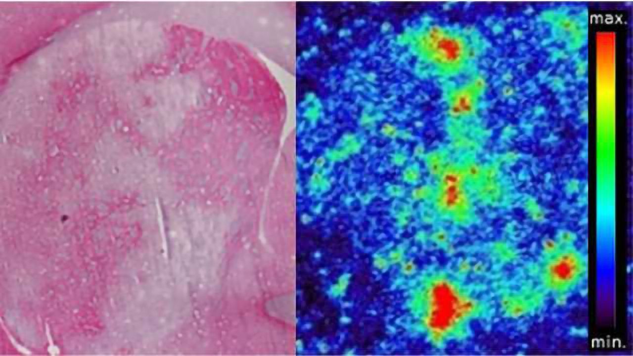 Sweet nanoparticles target stroke