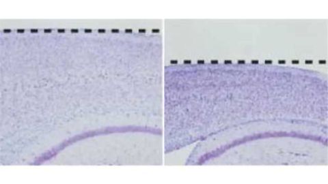 Study reveals how genetic changes lead to familial Alzheimer's disease