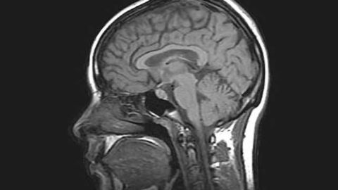 Brain networks differ among those with severe schizophrenia, study shows