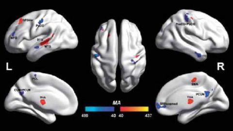 Autistic and non-autistic brain differences isolated for first time