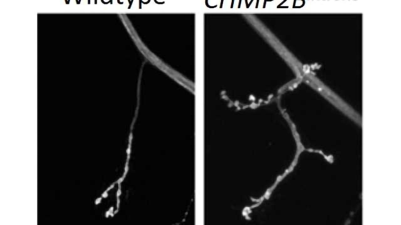 Novel steps in frontotemporal dementia progression identified