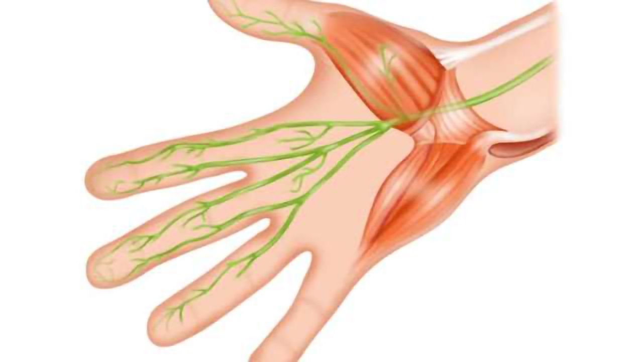 Study shows association between migraine and carpal tunnel syndrome