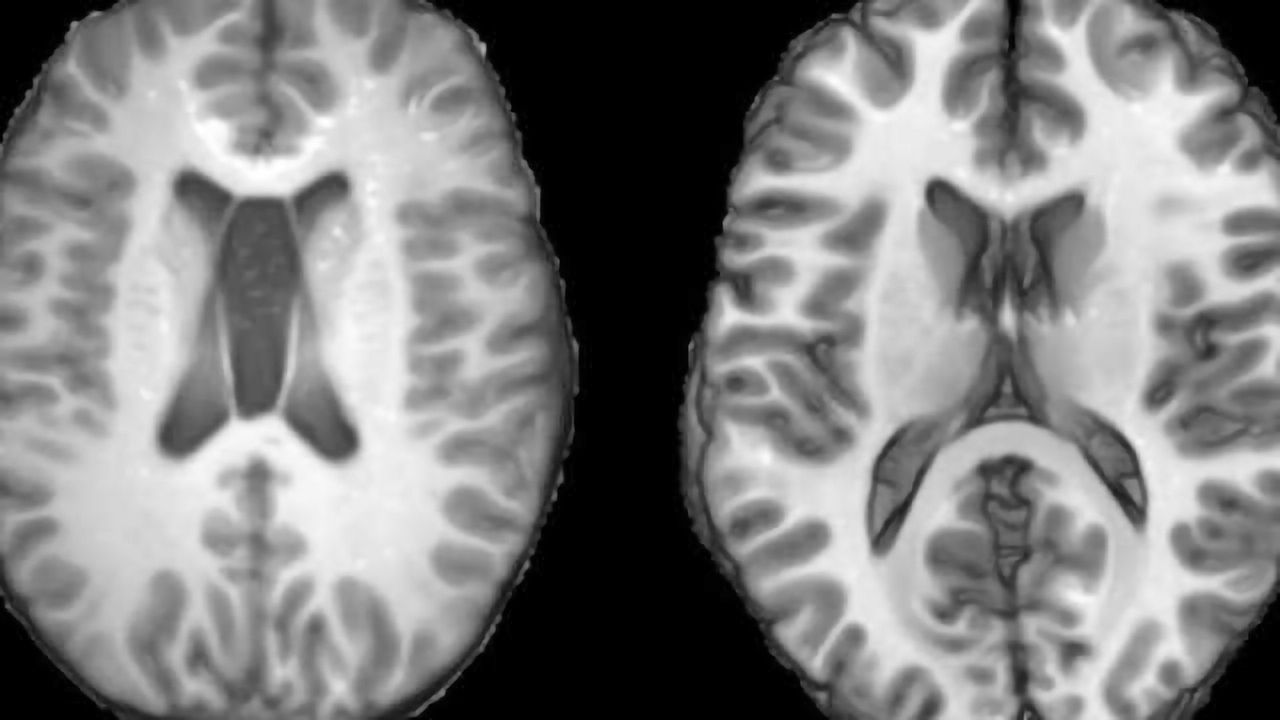 Head injury patients show signs of faster aging in the brain