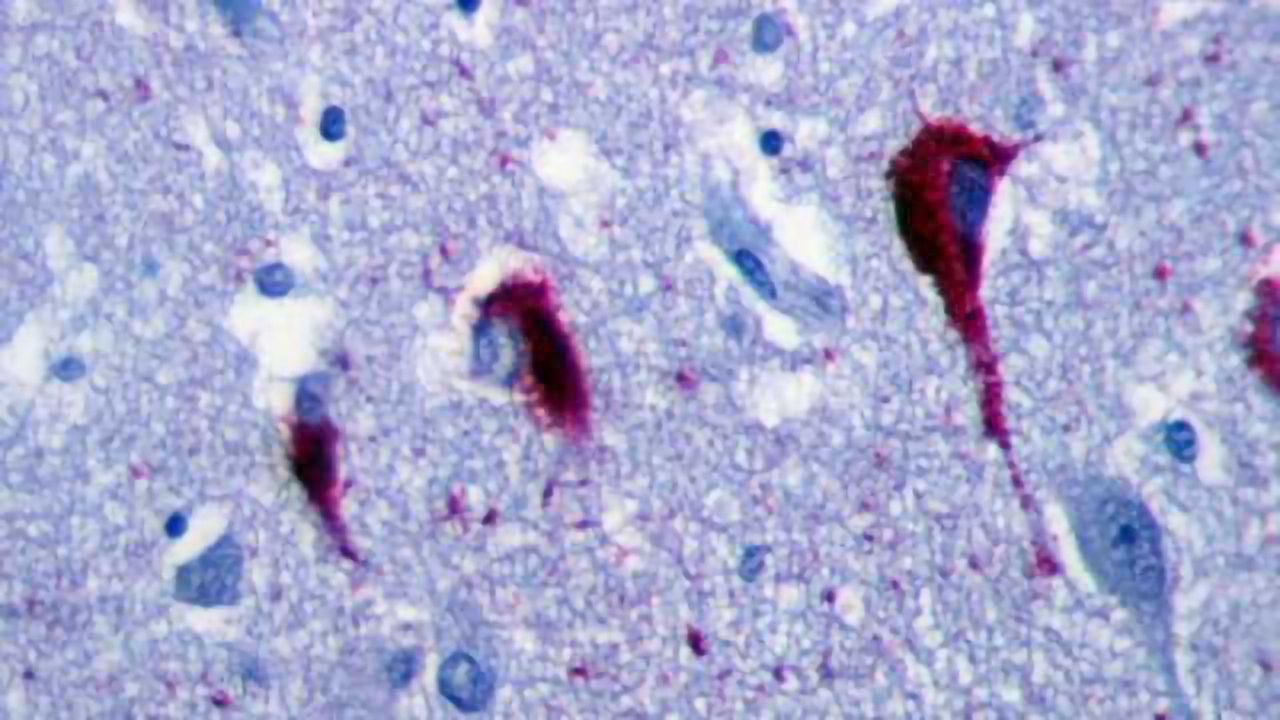 Immunotherapy used to reduce memory problems with Alzheimer’s disease