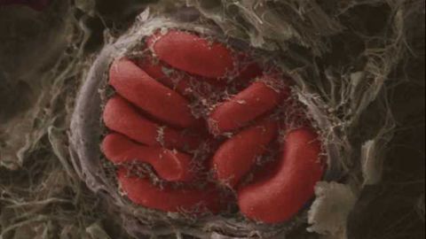 Promising new biomarkers for concussion found