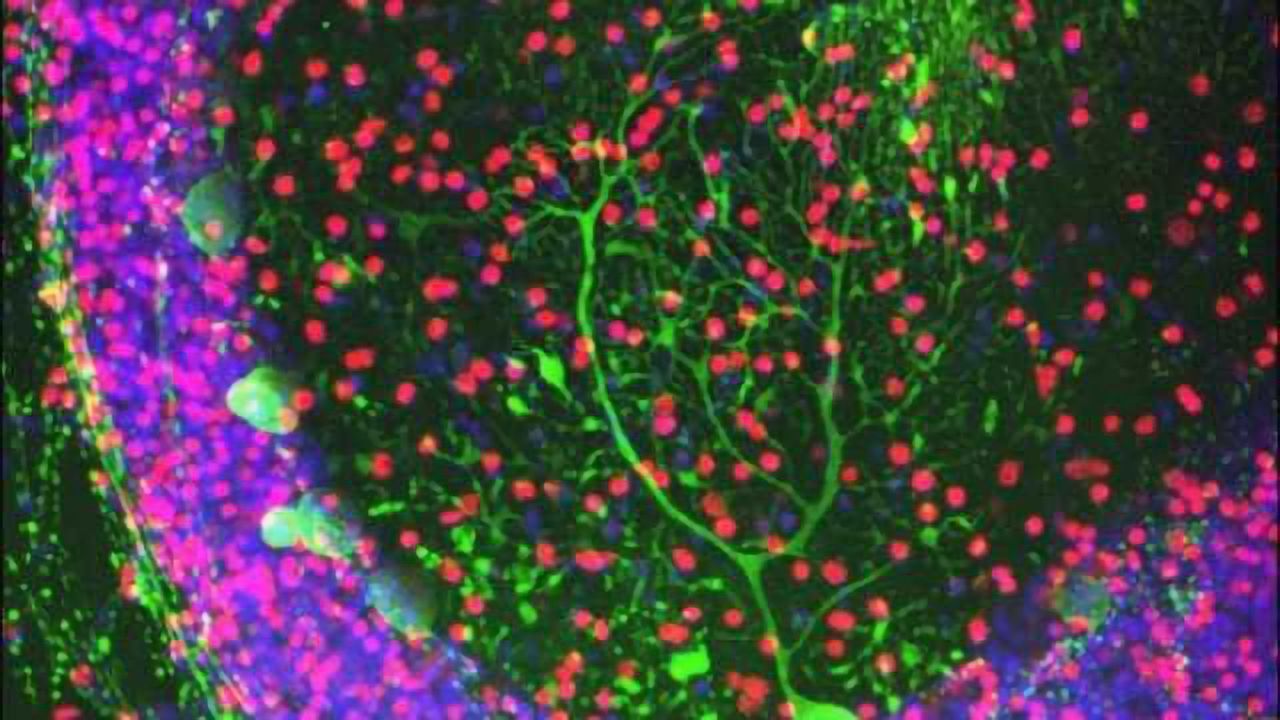 New link found between neurodegenerative diseases and abnormal immune responses