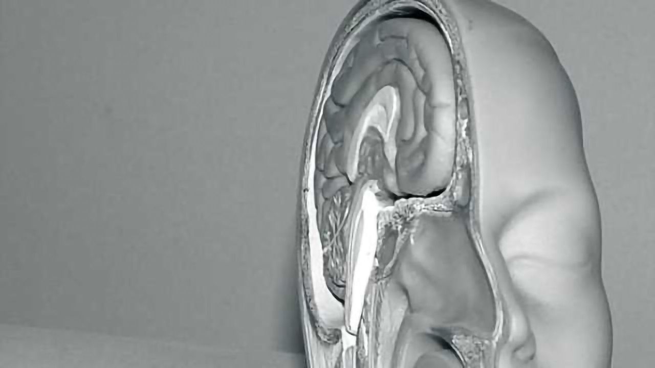 Clues found into cognitive dysfunction in chronic fatigue syndrome