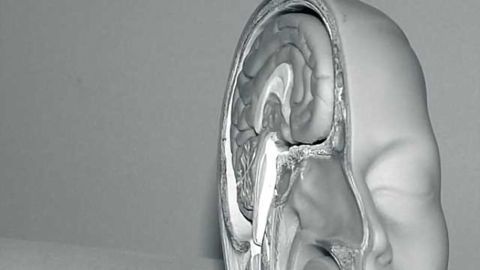 Clues found into cognitive dysfunction in chronic fatigue syndrome