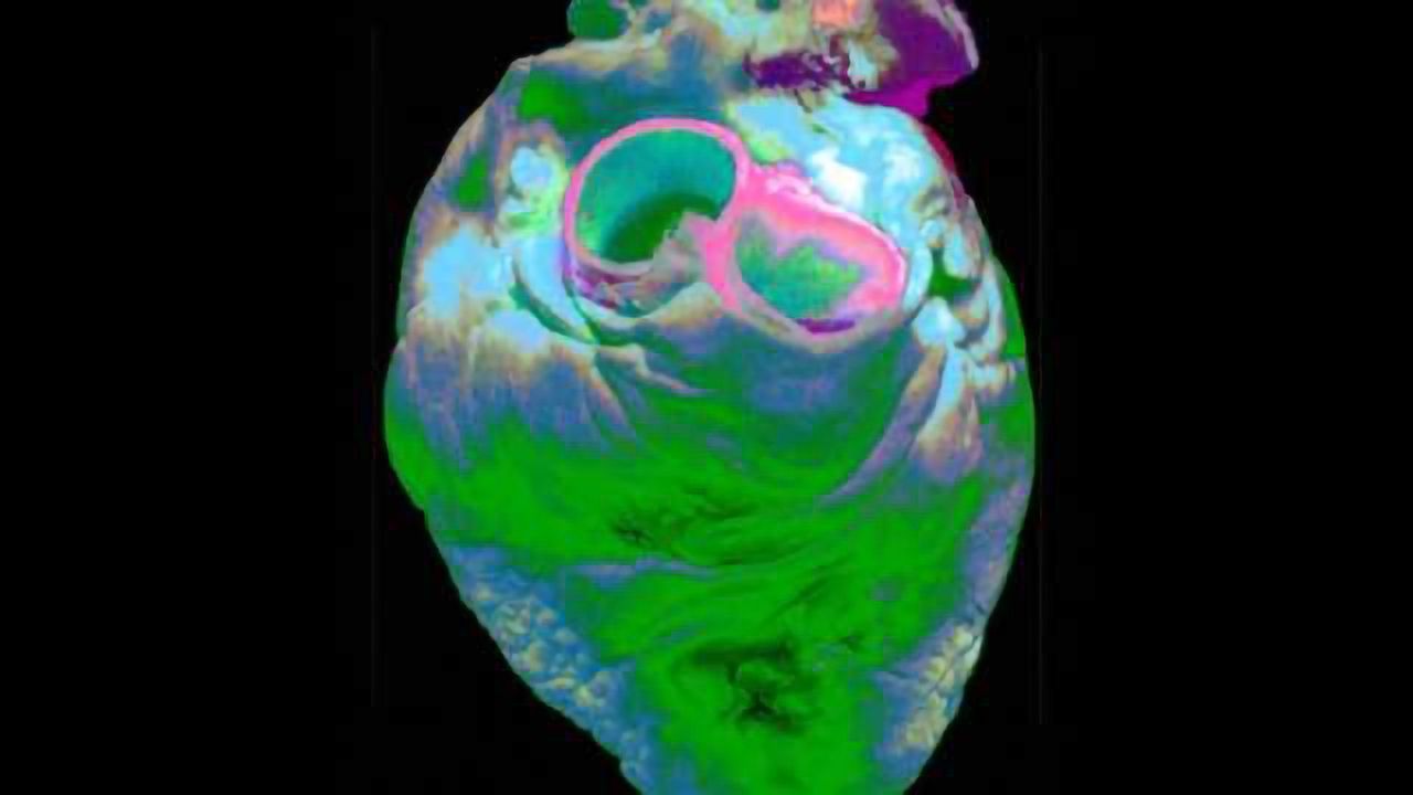 Presence of heart pouch may explain strokes of unknown origin, study finds