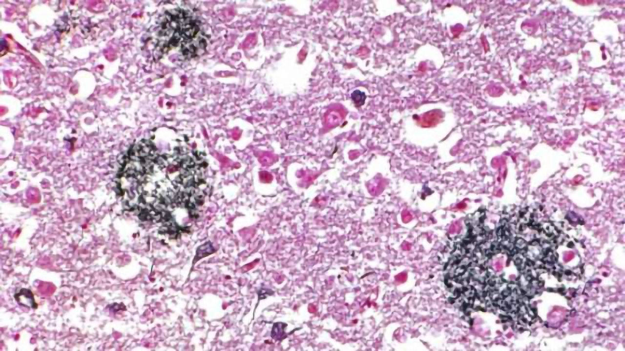 Promising drug discovery for the effects of Alzheimer’s disease
