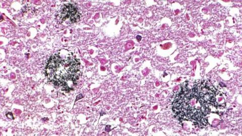 Promising drug discovery for the effects of Alzheimer’s disease