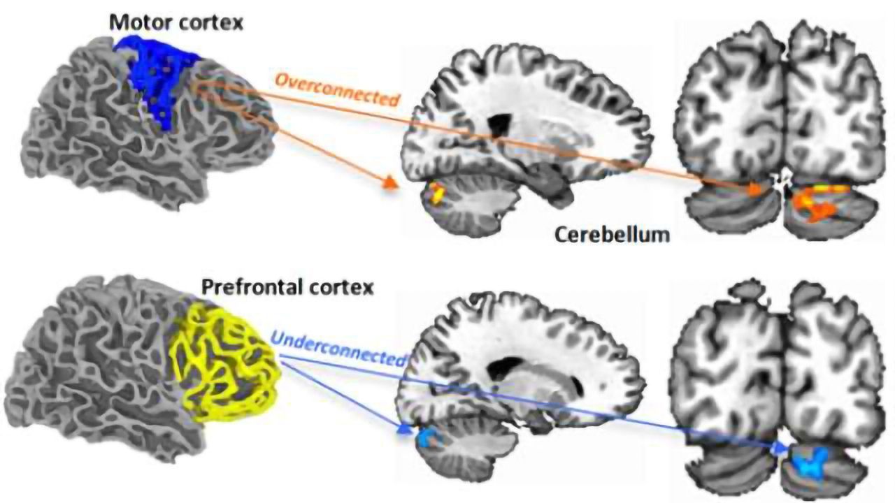 Autism's early neuronal 'neighborhood'