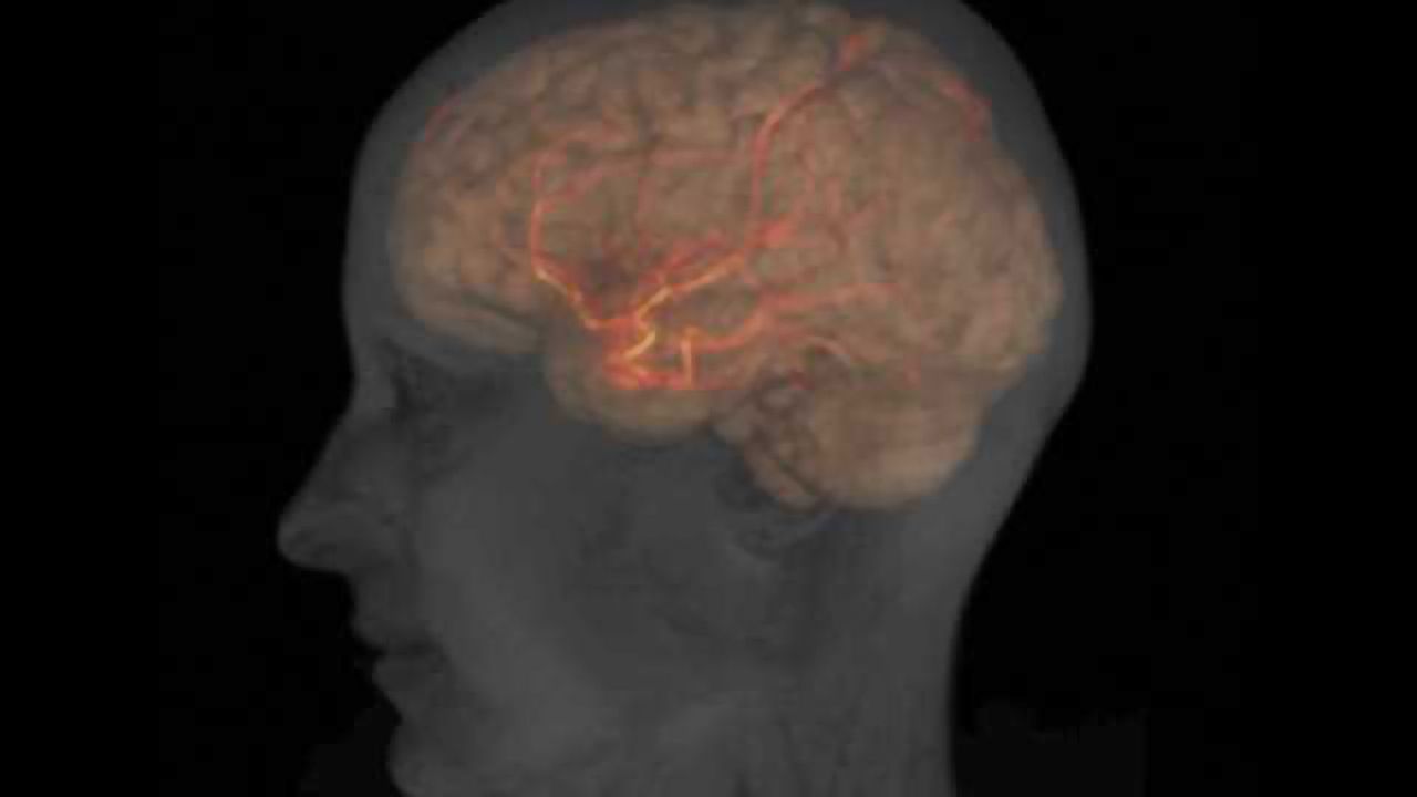 Stroke drug could be used more widely, benefit more patients