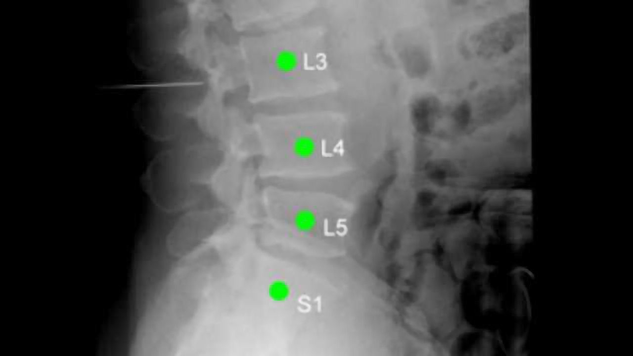 Spinal surgery: Right on target