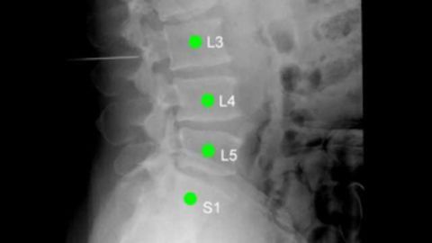 Spinal surgery: Right on target