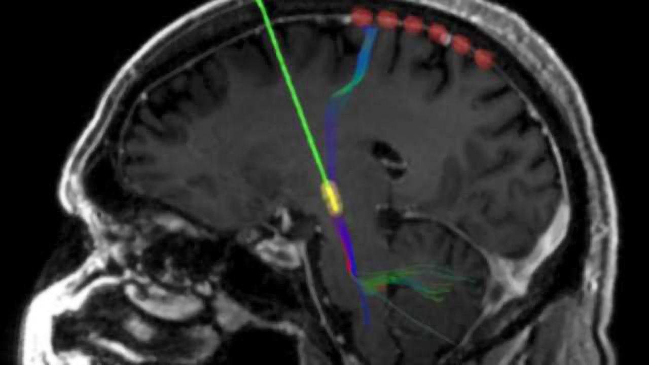 How deep-brain stimulation reshapes neural circuits in Parkinson's disease