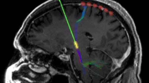 How deep-brain stimulation reshapes neural circuits in Parkinson's disease