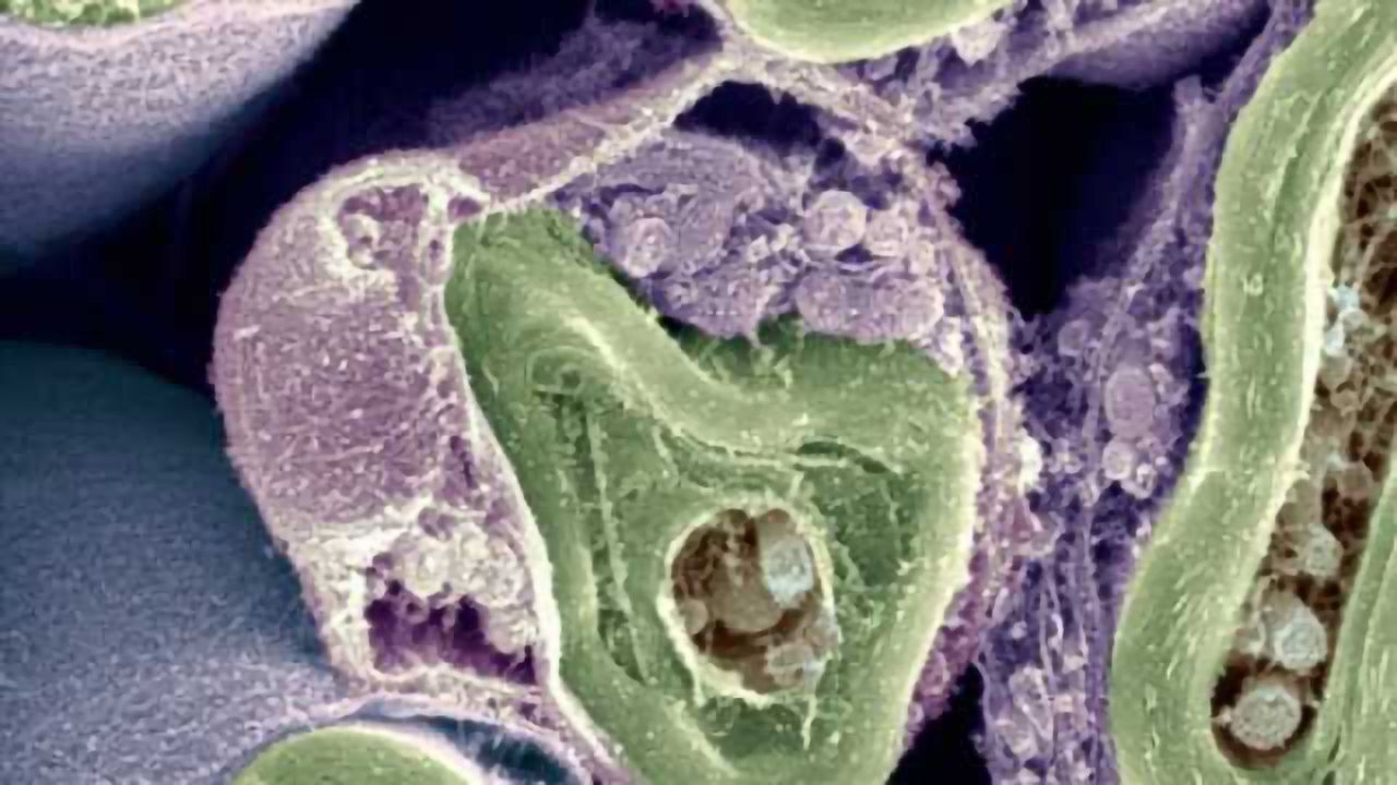 Experimental drug that may repair nerve damage in MS moves forward