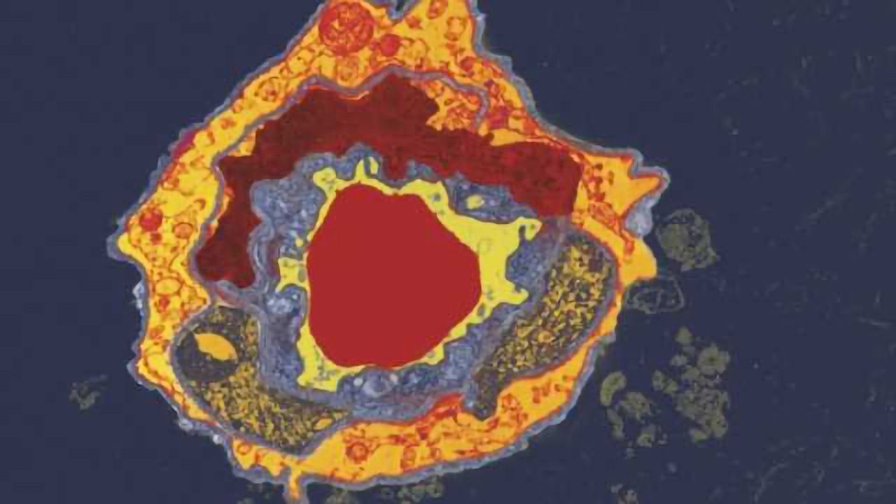 Electronic micropump to deliver treatments deep within the brain