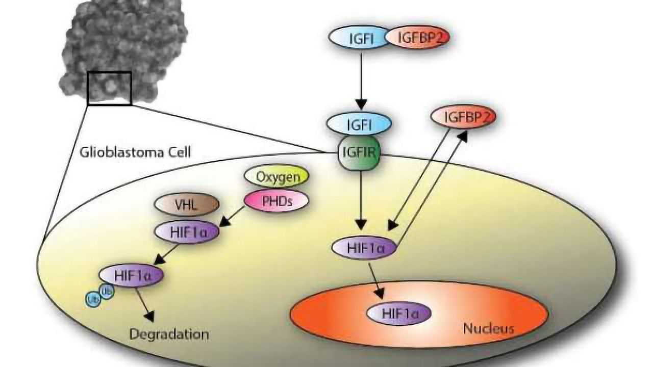 New tactic targets brain tumors with strategy for insulin-influenced tumor growth