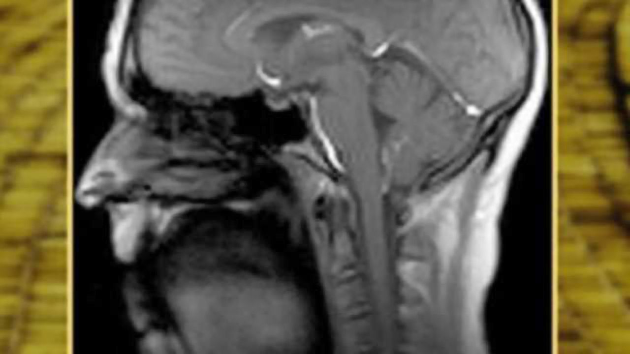 New super-fast MRI technique demonstrated with song 'If I Only Had a Brain'