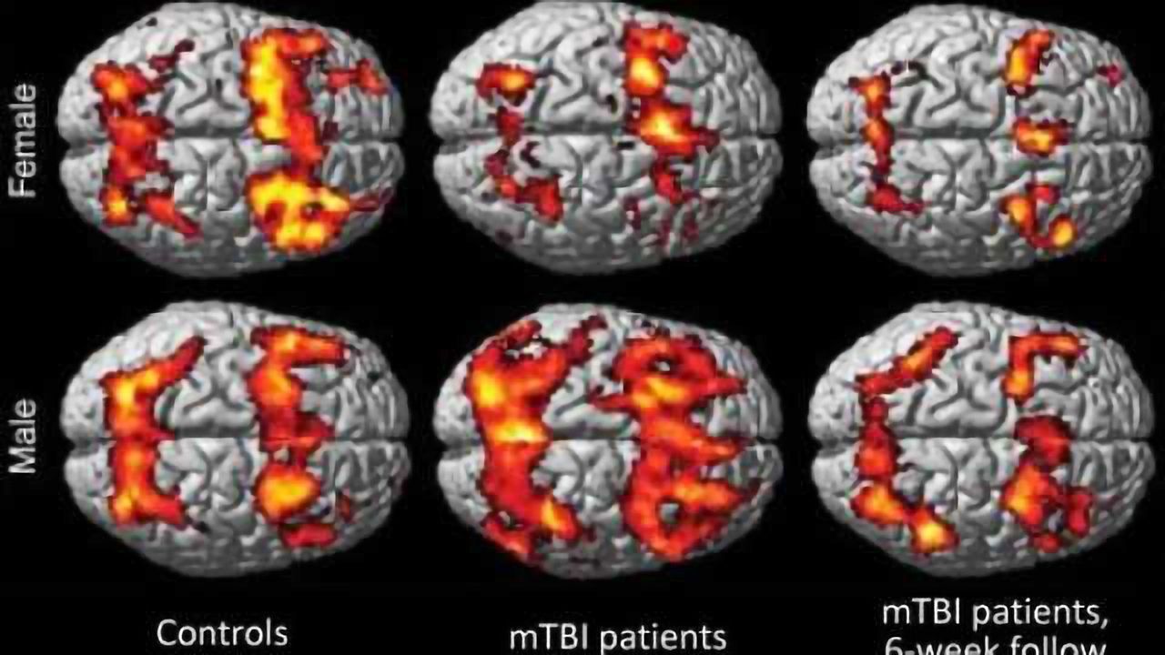 Women show persistent memory impairment after concussion
