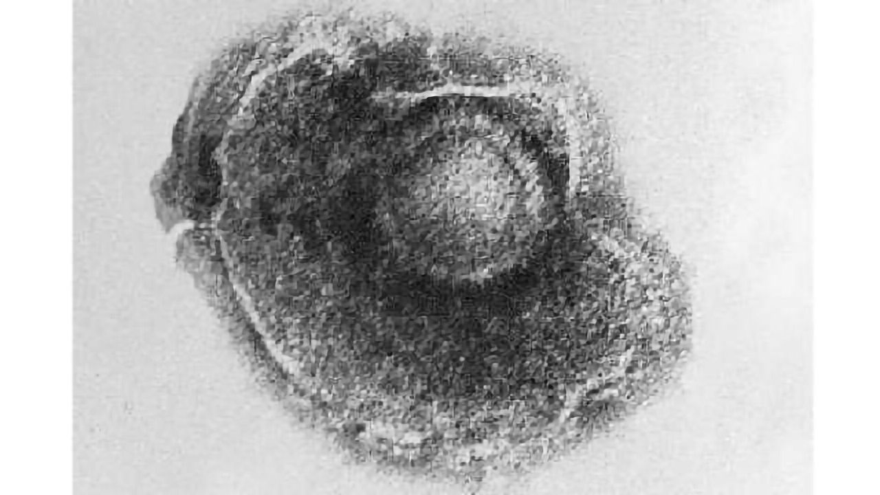 Chickenpox virus can cause stroke in HIV patients