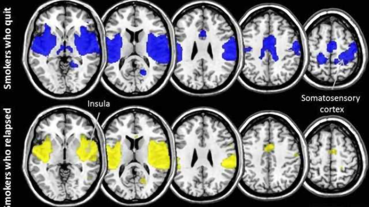 Brains of smokers who quit successfully might be wired for success