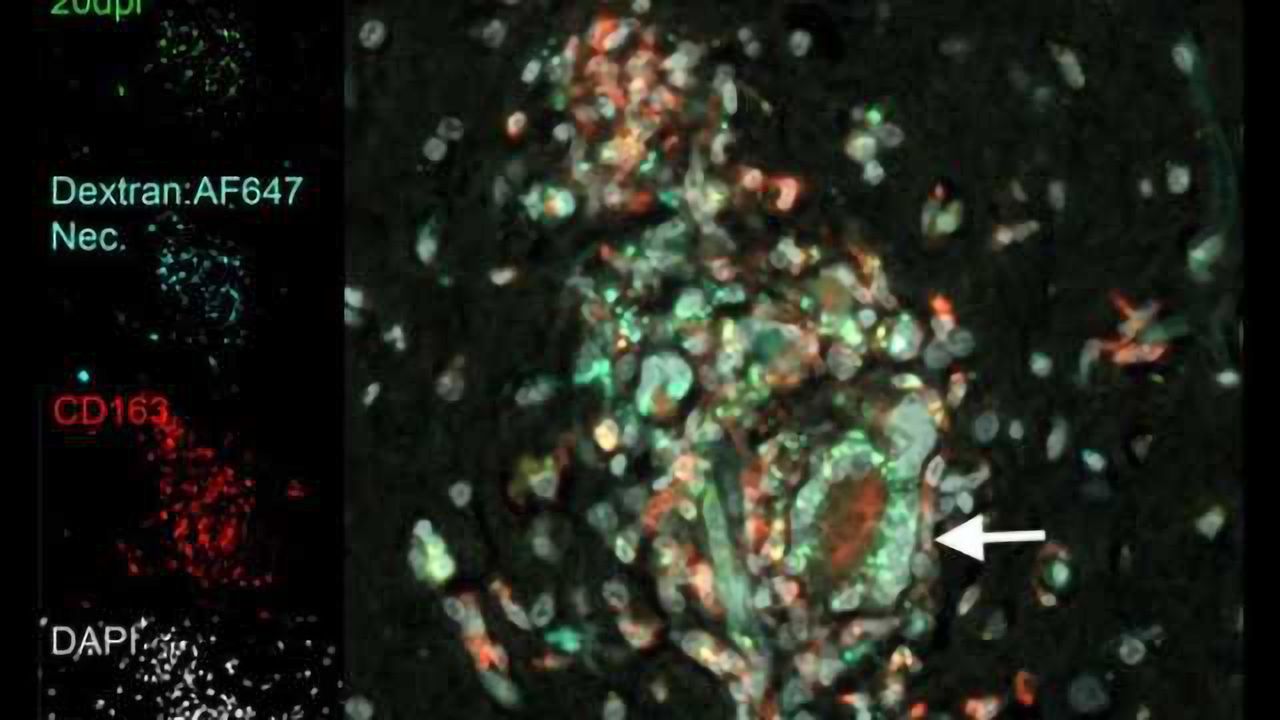 Study shows role of disease-fighting cells in HIV-related neurological damage