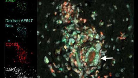 Study shows role of disease-fighting cells in HIV-related neurological damage