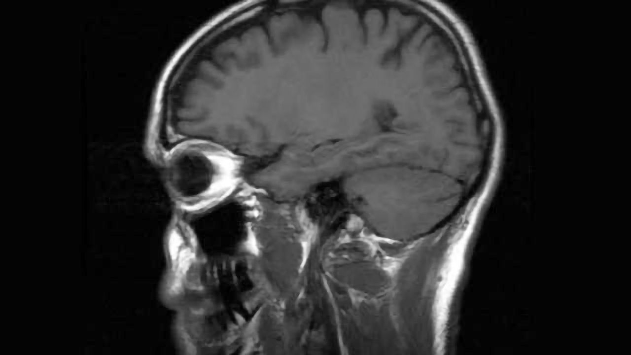 Researchers discover new ways to shut down signals involved in brain diseases