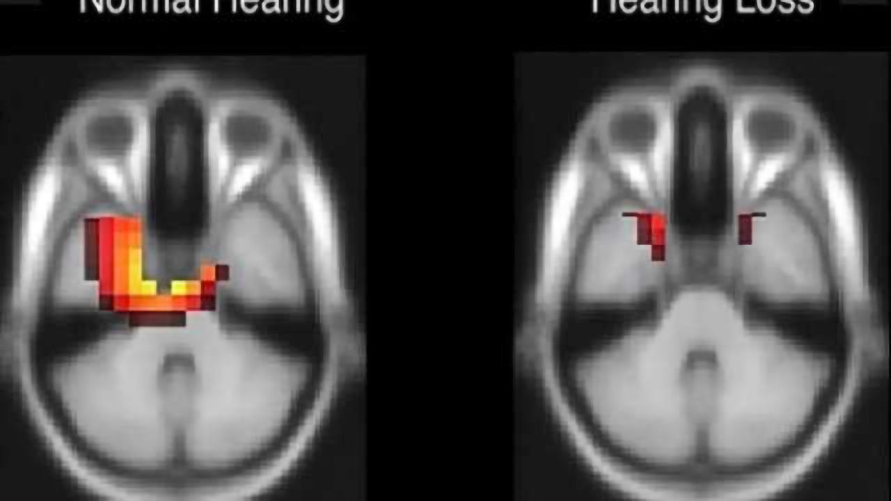 How does the brain respond to hearing loss?