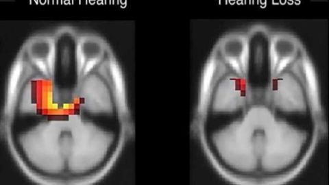 How does the brain respond to hearing loss?