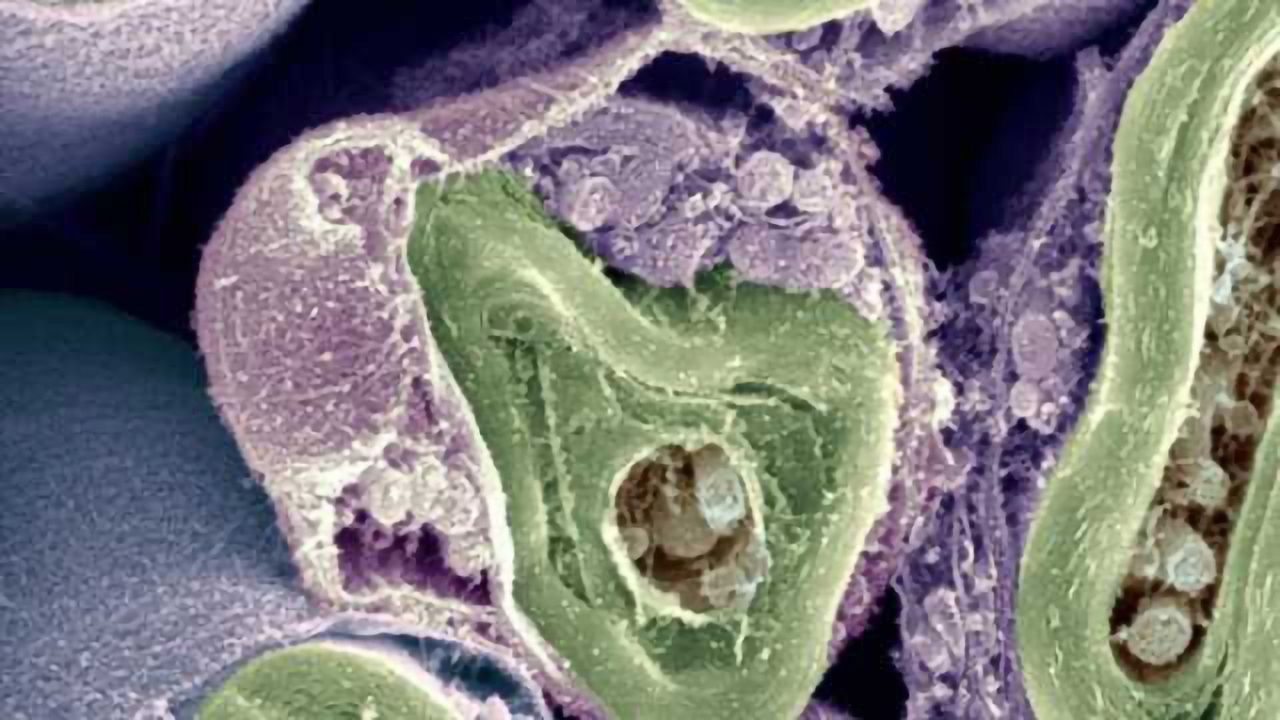 Discovery of a treatment to block the progression of multiple sclerosis