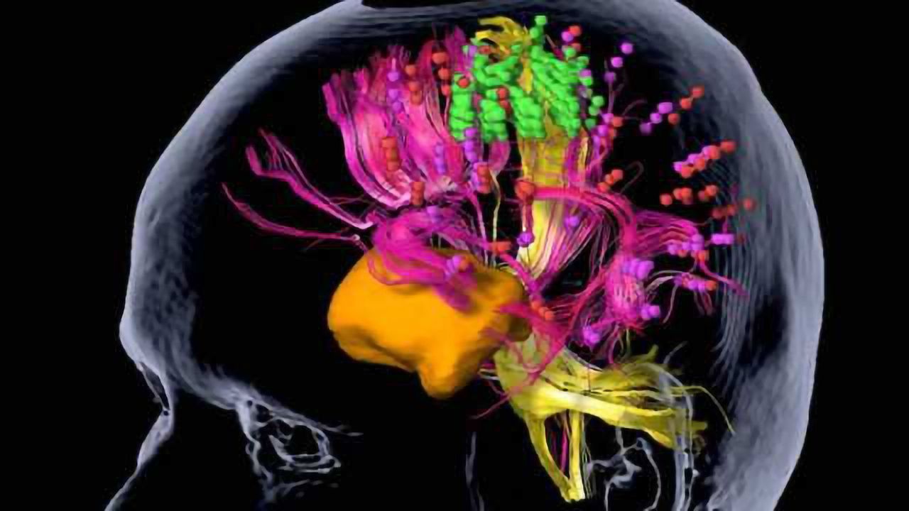 Brain tumors: Mapping of motor areas in the brain by magnetic stimulation