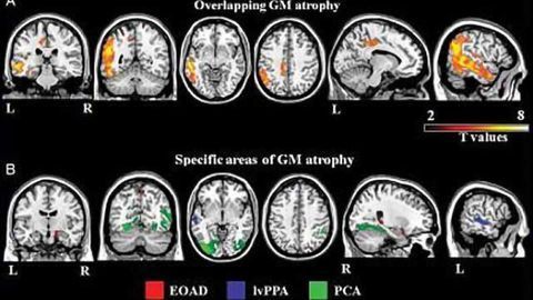 Imaging test may identify biomarker of Alzheimer's disease