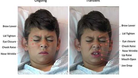 Staring pain in the face – Software “reads” kids’ expressions to measure pain levels